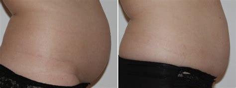 Aqualyx® Fat Dissolving Injections Clinicbe London