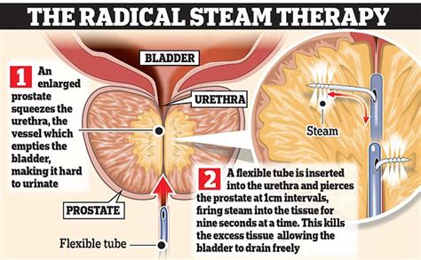 The Plain Truth Prostate Hope For Millions Of Over S Radical Five Minute Steaming Treatment