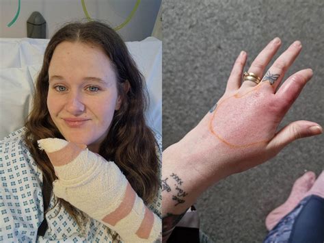 Widow Spider Bite Turned Out To Be A Spot On Womans Finger