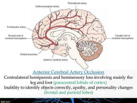 Sensory loss will be minimal. Basic Anatomy & Pathophysiology of ischemic stroke