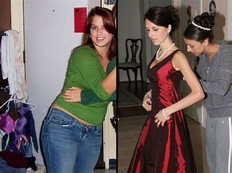 Anorexia Before And After Treatment