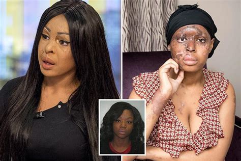 Acid Attack Victim Naomi Onis Anger At Friend Who Left Her