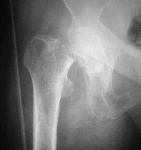 This Anteroposterior Radiograph Of The Right Hip Shows A Displaced