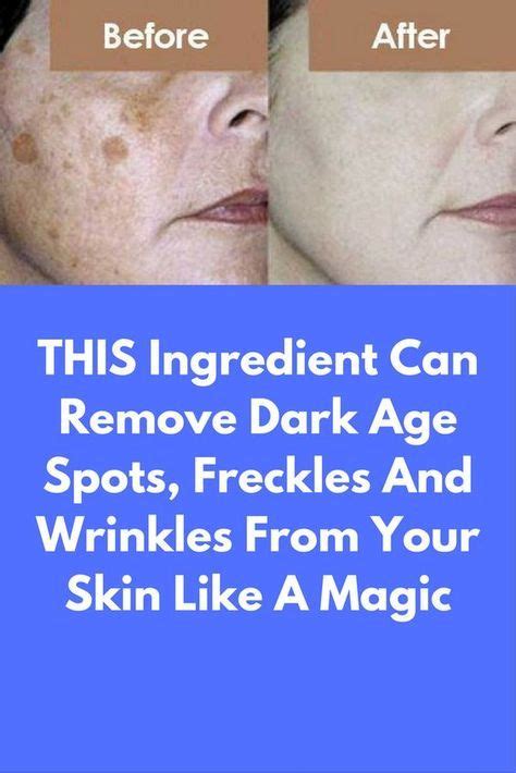 Freckles do not need treatment because they are harmless. THIS ingredient can remove dark age spots, freckles and ...