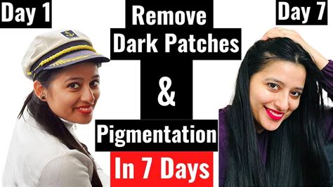 How To Remove Pigmentation Dark Patches Around Mouth Self Care