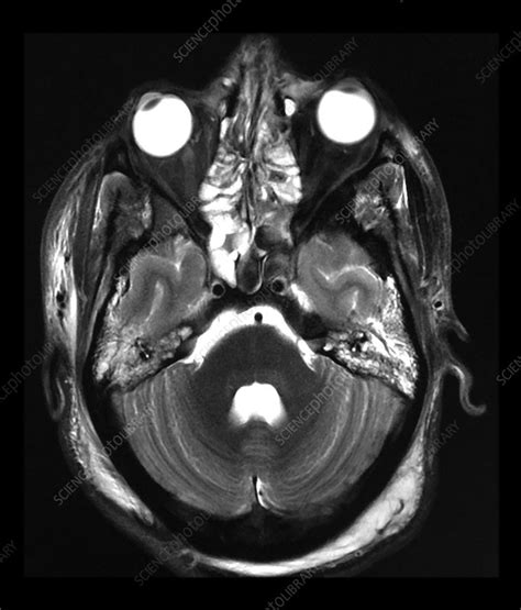 Traumatic Brain Injury Mri Stock Image C0432965 Science Photo