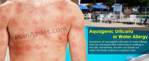 Aquagenic Urticaria Or Water Allergycausessymptomstreatmentrisk Factors