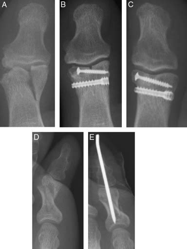 Do Broken Toes Need Follow Up In The Fracture Clinic The Journal Of