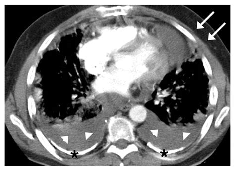 Primary Pericardial Mesothelioma In An Asbestos Exposed Patient With