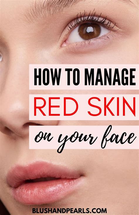 5 Ways To Manage Facial Redness Face Skin Care Redness On Face