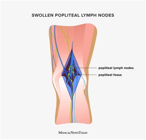 Swollen Popliteal Lymph Nodes Causes Anatomy And Diagnosis My Xxx Hot