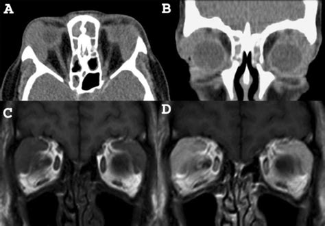 Lymphoma Unenhanced Ct A And B Bilateral Well Defined Lacrimal
