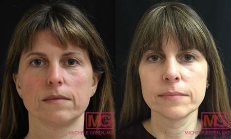 Thermage Neck Treatments Reducing Wrinkles And Lines In Neck Area