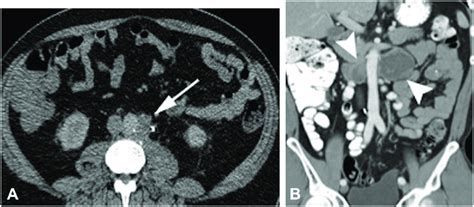 Retroperitoneal Metastasis A Left Para Aortic Lymph Node On A