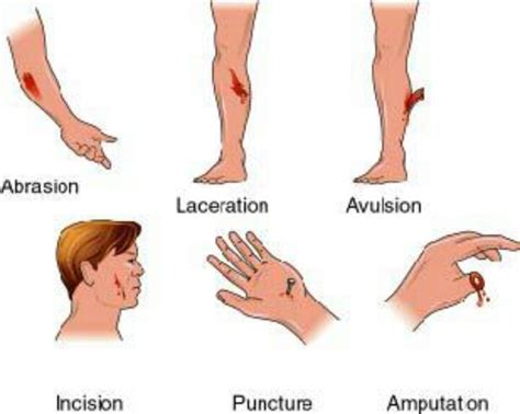 Type Of Wounds Wounds Nursing