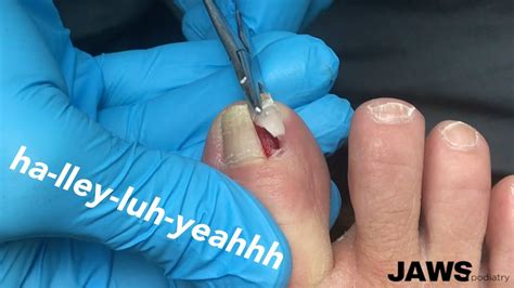 How Does A Doctor Remove Ingrown Toenail Tutorial Pics