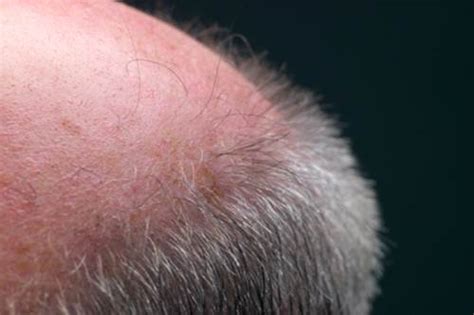 Tumori del cuoio capelluto | MedicinaLive