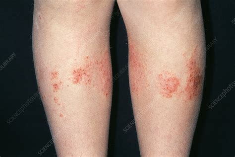Allergic Contact Dermatitis Stock Image M3200339 Science Photo