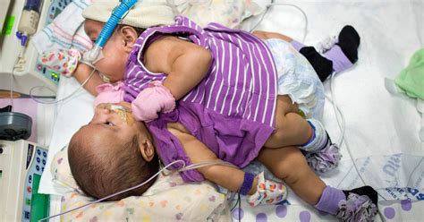 Hope Faith Strong For Mother Of Conjoined Texas Twins