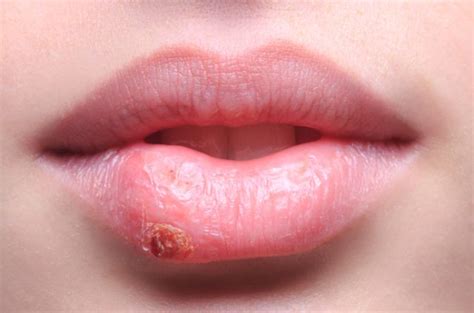 Here is the cold sore timeline with pictures and images for different stages of this is the beginning stage or the first day of infection. Home Remedies for Cold Sores?