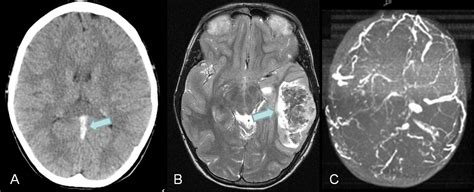 Cerebral Venous Thrombosisischemia Cancer Therapy Advisor