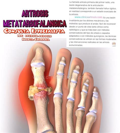 Tratamientos Para La Artrosis En Los Dedos Del Pie Visítenos Clínica