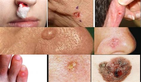 Warning The Earliest Signs Of Cancer Appear On Your Skin Wise Thinks