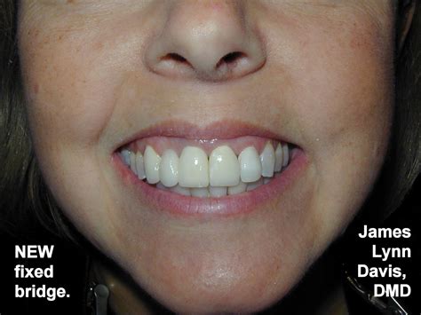 Davis Dental Diary Fixed Bridge Before And After