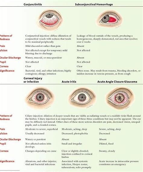 Red Eye Differential Dx Opthalmic Technician Eye Facts Optometry