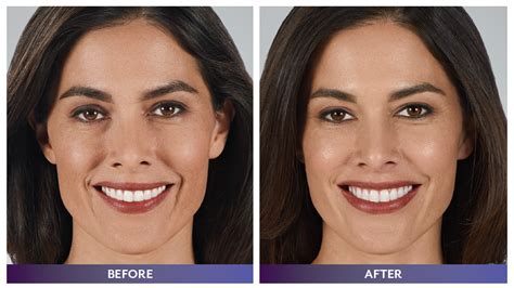 Fillers And Injectables Rejuv Spa And Cosmetic Center
