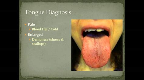 Tongue Diagnosis Example 2 Diagnostic Methods In Chinese Medicine