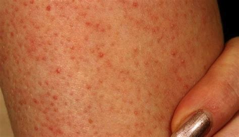 What Are Those Red Spots On Your Arms And Legs Red Skin Spots Red