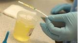 Is Protein in Urine Serious? - YouTube