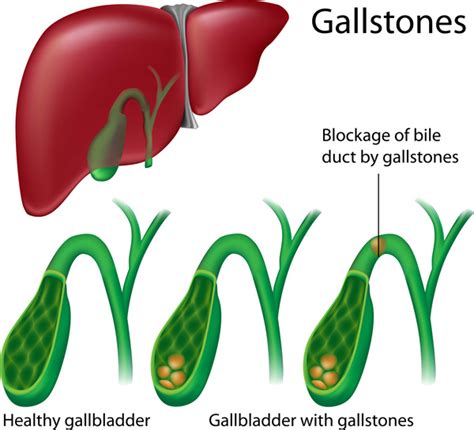 Gallbladder Problems Remove Gallstones Without Surgery