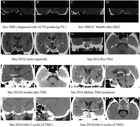 Computed Tomographic Ct Images Of Pituitary Tumors In The Case Two