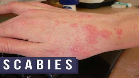 scabies causes transmission symptoms diagnosis treatment and prevention