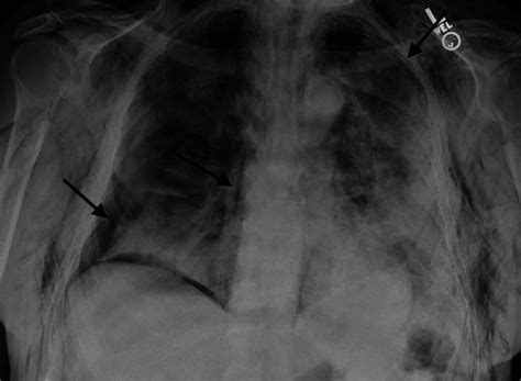 Cureus Covid Induced Spontaneous Pneumothoraxes Case Series