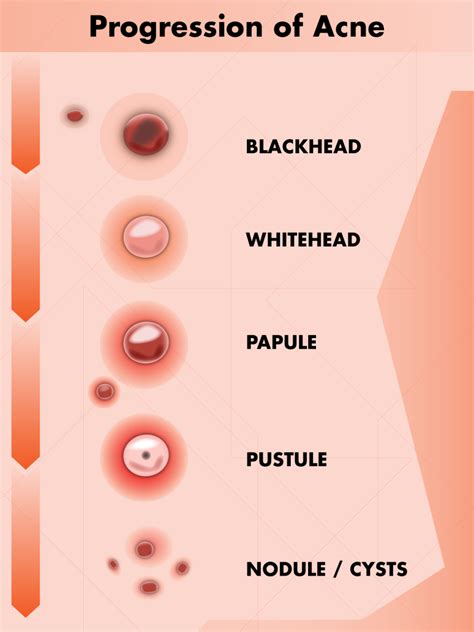 How To Tell The Difference Between Herpes And Pimples With Photos