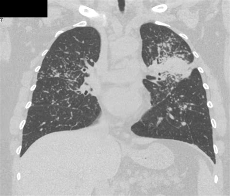 Miliary Tb With Tree In Bud Appearance Chest Case Studies Ctisus Ct