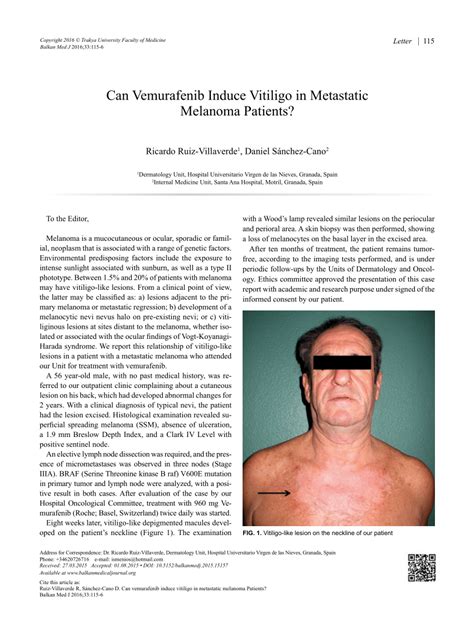 Pdf Can Vemurafenib Induce Vitiligo In Metastatic Melanoma Patients
