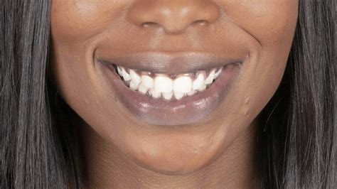 Black Gums And Spots On Gums 7 Amazing Facts About Dark Gums Treatment