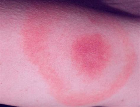 Lyme Disease Rash Pictures Symptoms Causes Treatment