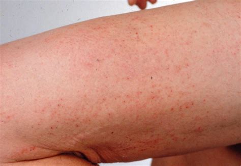 Dermatitis Herpetiformis Causes Treatment And Pictures