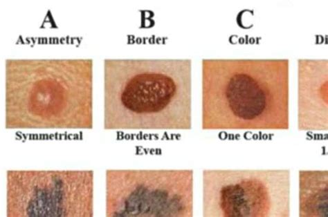 signs you have skin cancer hot sex picture
