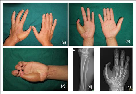 Figure 2 From Osteocutaneous Hemi Fibula Flap And Index Finger