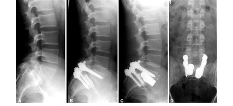 39 Year Old Patient With Spondylolisthesis L5s1 A Posterior