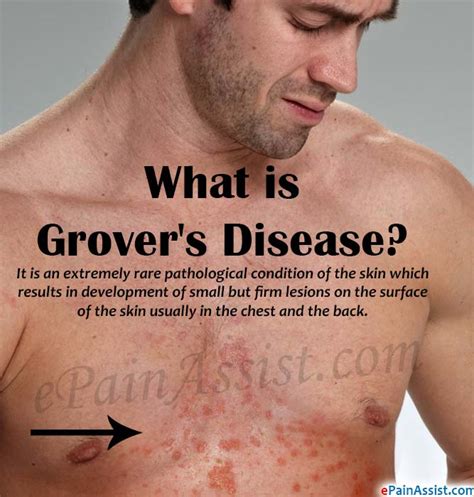 What Is Grovers Disease Quotes Viral