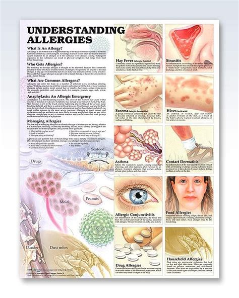 Understanding Allergies Chart 20x26 Most Common Allergies Allergies