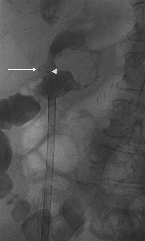 First Experience With The Use Of A Collagen Fistula Plug To Treat