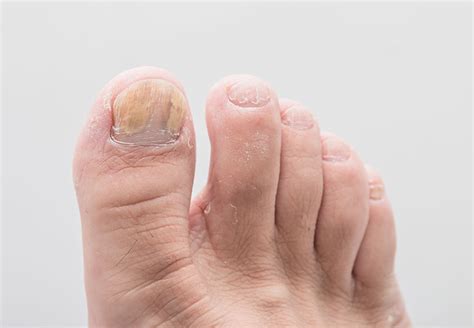 Symptoms Of Psoriatic Arthritis Toenails Eshealthtips